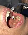 Low volume oral suction as used by a dental hygienist or dental surgeon.