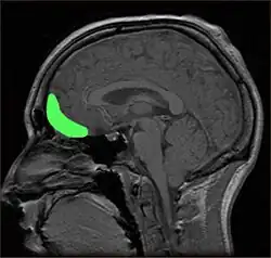 MRI of a skull, highlighting the orbitofrontal cortex in green.