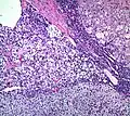 Adrenocortical adenoma with focal necrosis