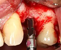 A series of slow-speed drills create and gradually enlarge a site in the jaw for the implant to be placed. The hole is called an osteotomy.