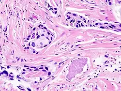 Histopathology of invasive ductal carcinoma of the breast representing a scirrhous growth.