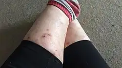 Photo of a women's lower legs with scars and wounds beginning to heal after a skin-picking episode cause by excoriation disorder.