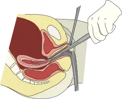 Dilation and curettage is performed to remove the firmly attached placental fragments, for the restoration of declined progesterone level to initiate lactation.