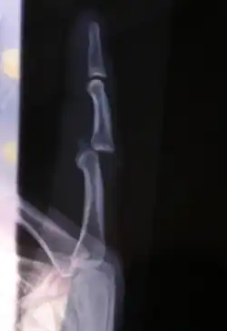 Radiograph of left index finger dislocation