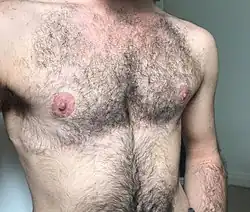 An image of a transgender man's chest post-surgery and healed