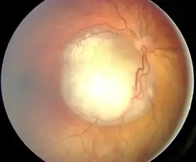 A fundus with retinoblastoma