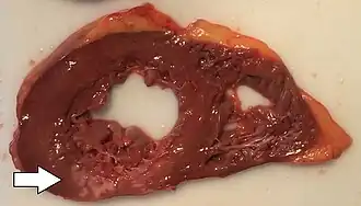 Cross-section of the heart, showing an old myocardial infarction of the posterior wall of the left ventricle (seen as pale areas).