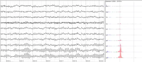 Human EEG with prominent alpha-rhythm