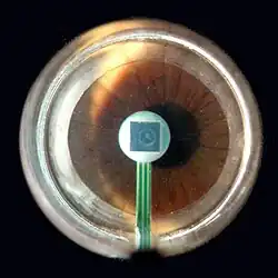 SensorTip of a PASCAL tonometer in contact with patient's cornea