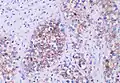 The germ cell markers OCT 3/4 and CD117 (positive immunohistochemistry pictured) are useful for diagnosis.[10]