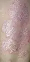 A person's arm covered with plaque psoriasis