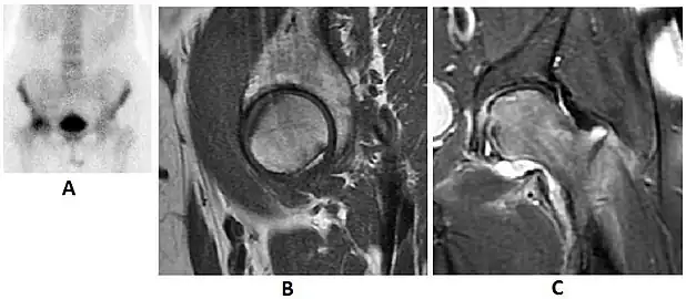 Scintigraphy (A), sagittal T1 (B), and coronal PD fat sat of a patient with a subchondral fracture of the femoral head with convex shape to the articular surface.[1]