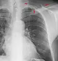 The margins of the supraclavicular fossa are often visible on chest X-ray