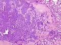 Micrograph of papillary thyroid carcinoma demonstrating prominent papillae with fibrovascular cores. H&E stain.