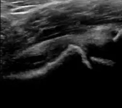 Step in the femoral head-neck junction in a patient with SCFE.
