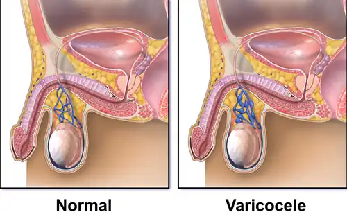 Varicocele