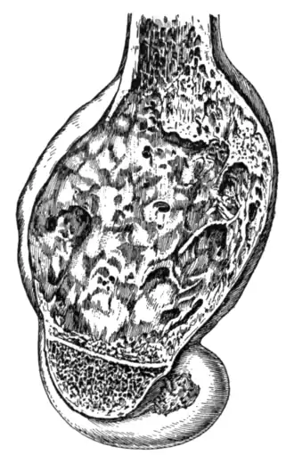 Fig. 14.—Lower end of a femur in longitudinal section, showing a myeloma.