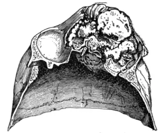 Fig. 8.—Osteoma of the left frontal sinus (seen from below).